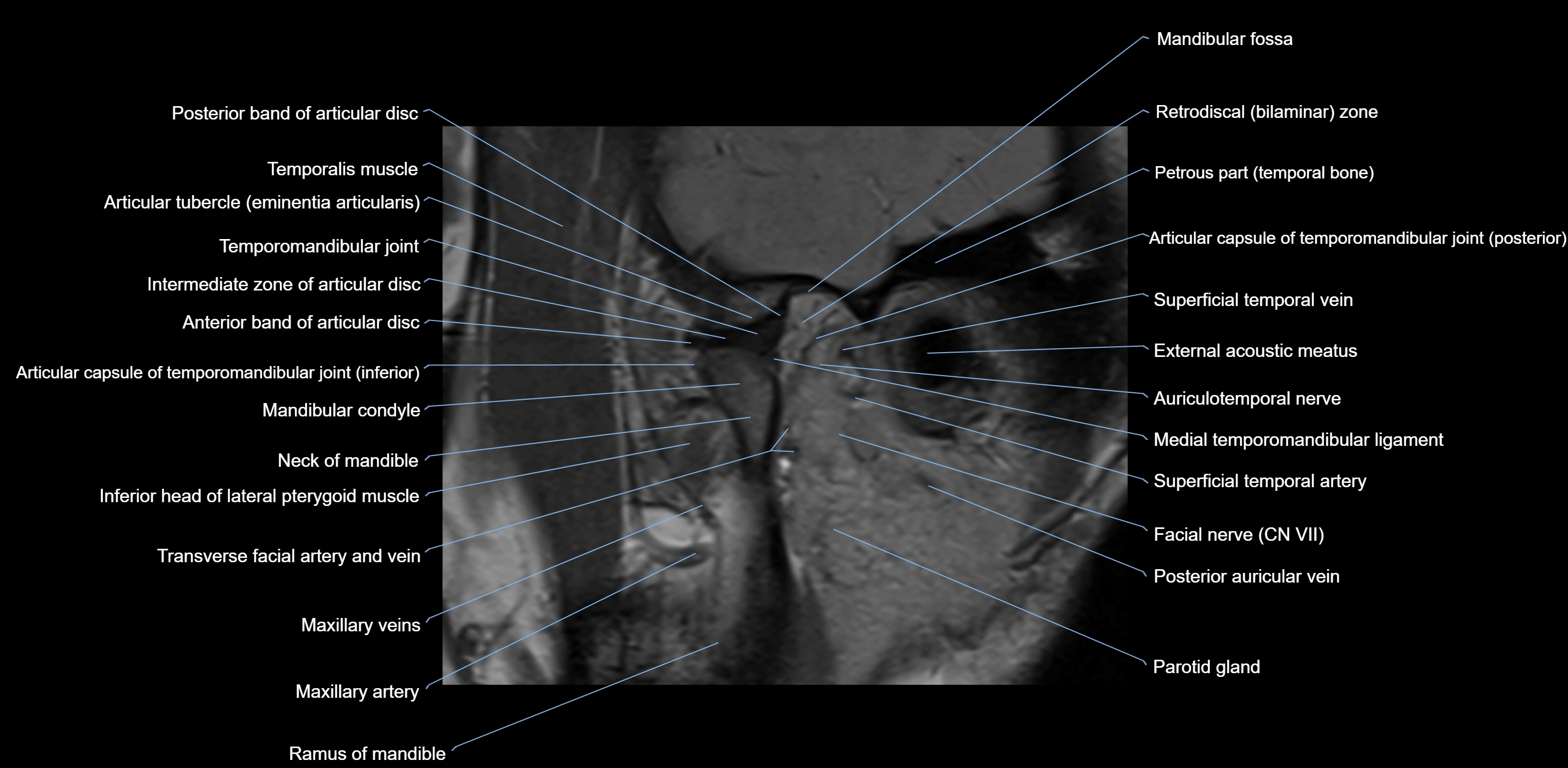 MRI TMJ sagittal open  mouth cross sectional 3T anatomy -img-00001-00007.webp